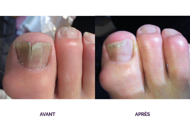 Photos avant et après traitement